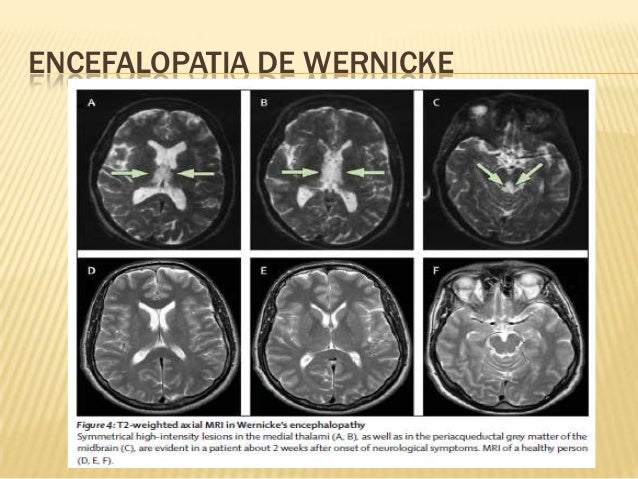 Encefalopatia de wernicke