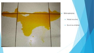  Bilirrubinúria
 Visível na urina
 Ou só na urinálise
 
