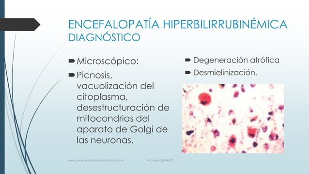 ENCEFALOPATIA POR HIPERBILIRRUBINEMIA PRESENTACION | PPTX