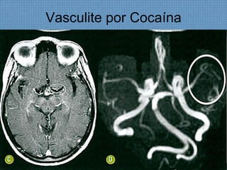 Vasculite por Cocaína
 
