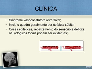 CLÍNICA
• Síndrome vasoconstritora reversível;
• Inicia o quadro geralmente por cefaléia súbita;
• Crises epiléticas, rebaixamento do sensório e déficits
neurológicos focais podem ser evidentes;
 