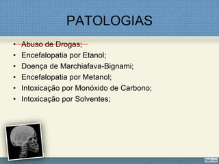 PATOLOGIAS
• Abuso de Drogas;
• Encefalopatia por Etanol;
• Doença de Marchiafava-Bignami;
• Encefalopatia por Metanol;
• Intoxicação por Monóxido de Carbono;
• Intoxicação por Solventes;
 