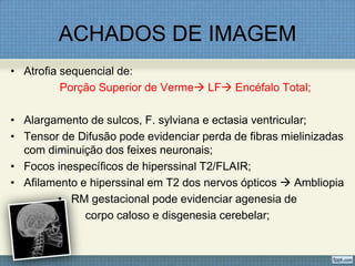 ACHADOS DE IMAGEM
• Atrofia sequencial de:
Porção Superior de Verme LF Encéfalo Total;
• Alargamento de sulcos, F. sylviana e ectasia ventricular;
• Tensor de Difusão pode evidenciar perda de fibras mielinizadas
com diminuição dos feixes neuronais;
• Focos inespecíficos de hiperssinal T2/FLAIR;
• Afilamento e hiperssinal em T2 dos nervos ópticos  Ambliopia
• RM gestacional pode evidenciar agenesia de
corpo caloso e disgenesia cerebelar;
 
