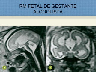 RM FETAL DE GESTANTE
ALCOOLISTA
 
