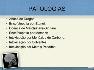 PATOLOGIAS
• Abuso de Drogas;
• Encefalopatia por Etanol;
• Doença de Marchiafava-Bignami;
• Encefalopatia por Metanol;
• Intoxicação por Monóxido de Carbono;
• Intoxicação por Solventes;
• Intoxicação por Metais Pesados;
 