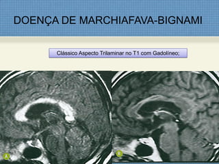 DOENÇA DE MARCHIAFAVA-BIGNAMI
Clássico Aspecto Trilaminar no T1 com Gadolíneo;
 