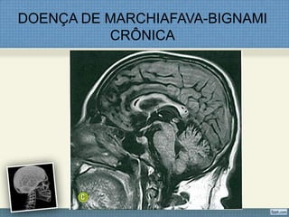 DOENÇA DE MARCHIAFAVA-BIGNAMI
CRÔNICA
 