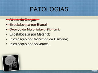 PATOLOGIAS
• Abuso de Drogas;
• Encefalopatia por Etanol;
• Doença de Marchiafava-Bignami;
• Encefalopatia por Metanol;
• Intoxicação por Monóxido de Carbono;
• Intoxicação por Solventes;
 