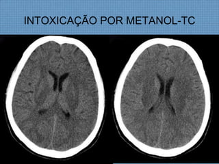 INTOXICAÇÃO POR METANOL-TC
 