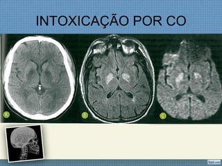 INTOXICAÇÃO POR CO
 