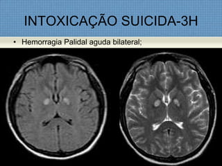 INTOXICAÇÃO SUICIDA-3H
• Hemorragia Palidal aguda bilateral;
 