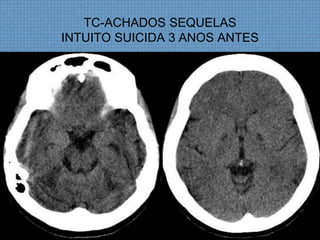 TC-ACHADOS SEQUELAS
INTUITO SUICIDA 3 ANOS ANTES
 