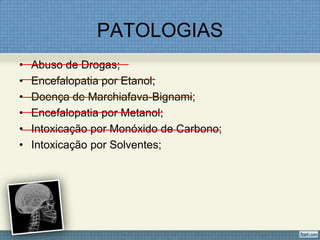 PATOLOGIAS
• Abuso de Drogas;
• Encefalopatia por Etanol;
• Doença de Marchiafava-Bignami;
• Encefalopatia por Metanol;
• Intoxicação por Monóxido de Carbono;
• Intoxicação por Solventes;
 