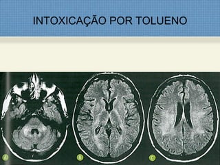 INTOXICAÇÃO POR TOLUENO
 