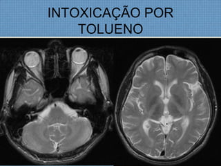 INTOXICAÇÃO POR
TOLUENO
 