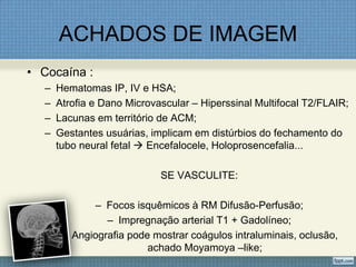 ACHADOS DE IMAGEM
• Cocaína :
– Hematomas IP, IV e HSA;
– Atrofia e Dano Microvascular – Hiperssinal Multifocal T2/FLAIR;
– Lacunas em território de ACM;
– Gestantes usuárias, implicam em distúrbios do fechamento do
tubo neural fetal  Encefalocele, Holoprosencefalia...
SE VASCULITE:
– Focos isquêmicos à RM Difusão-Perfusão;
– Impregnação arterial T1 + Gadolíneo;
– Angiografia pode mostrar coágulos intraluminais, oclusão,
achado Moyamoya –like;
 