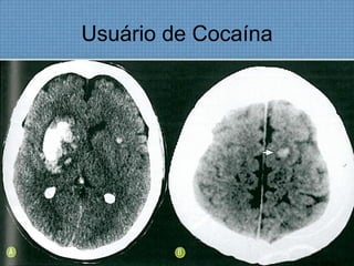 Usuário de Cocaína
 