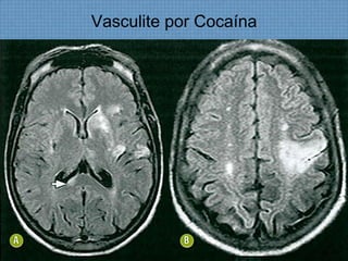 Vasculite por Cocaína
 