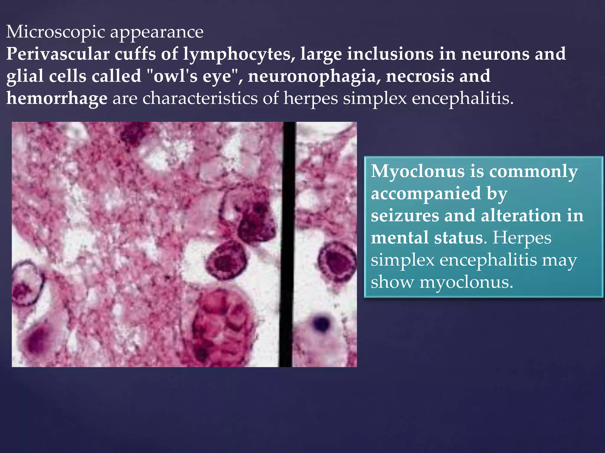 Microscopic appearance
Perivascular cuffs of lymphocytes, large inclusions in neurons and
glial cells called "owl's eye", neuronophagia, necrosis and
hemorrhage are characteristics of herpes simplex encephalitis.
Myoclonus is commonly
accompanied by
seizures and alteration in
mental status. Herpes
simplex encephalitis may
show myoclonus.
 