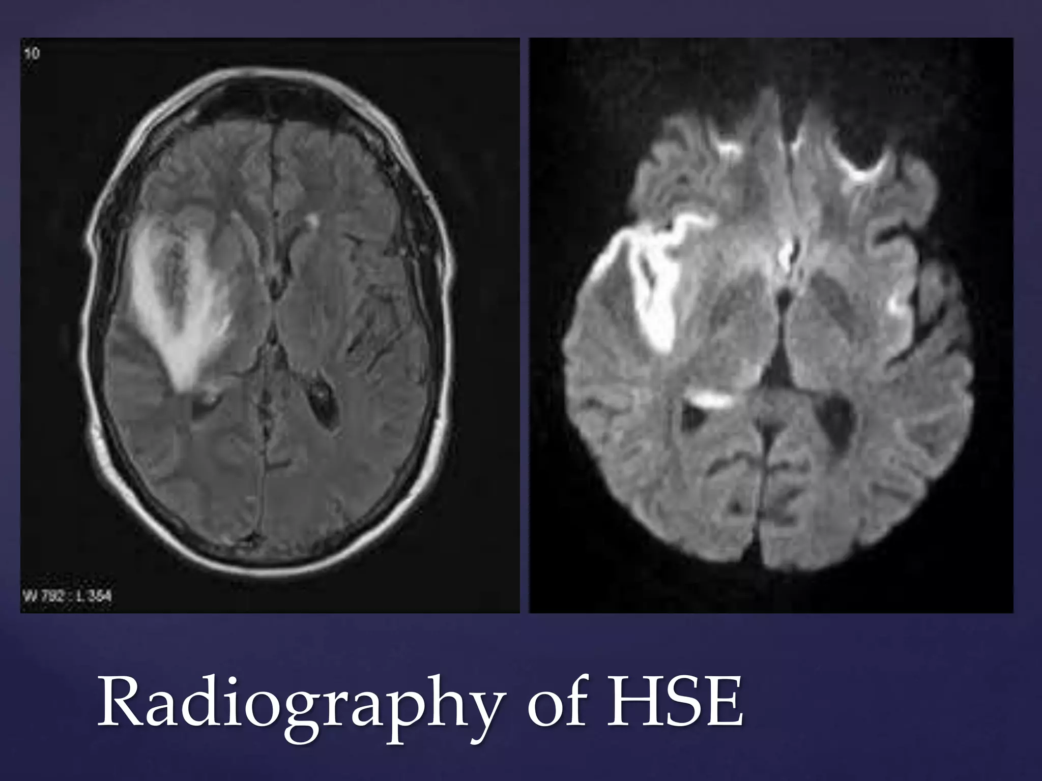 Radiography of HSE
 