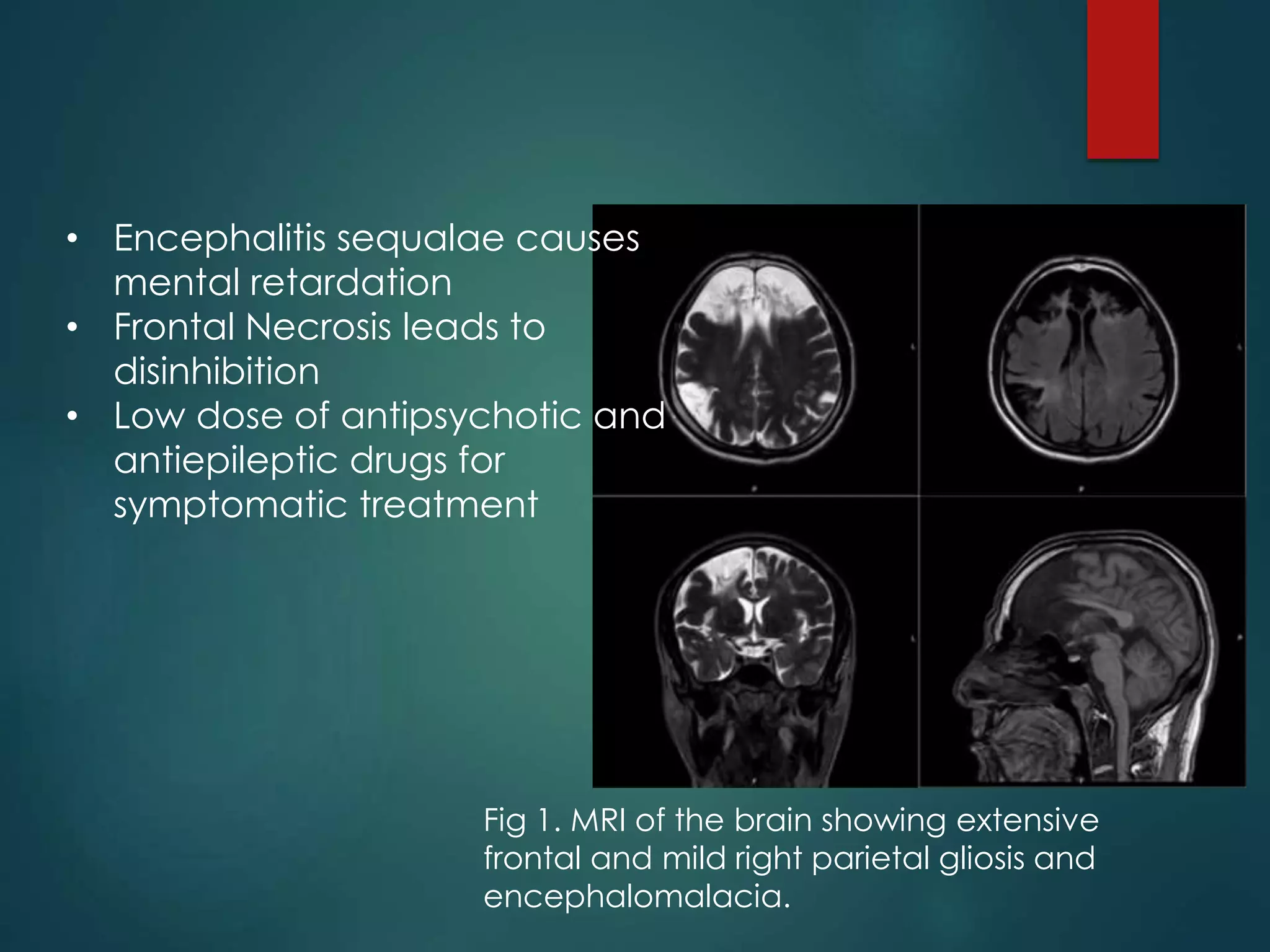 • Encephalitis sequalae causes
mental retardation
• Frontal Necrosis leads to
disinhibition
• Low dose of antipsychotic and
antiepileptic drugs for
symptomatic treatment
Fig 1. MRI of the brain showing extensive
frontal and mild right parietal gliosis and
encephalomalacia.
 