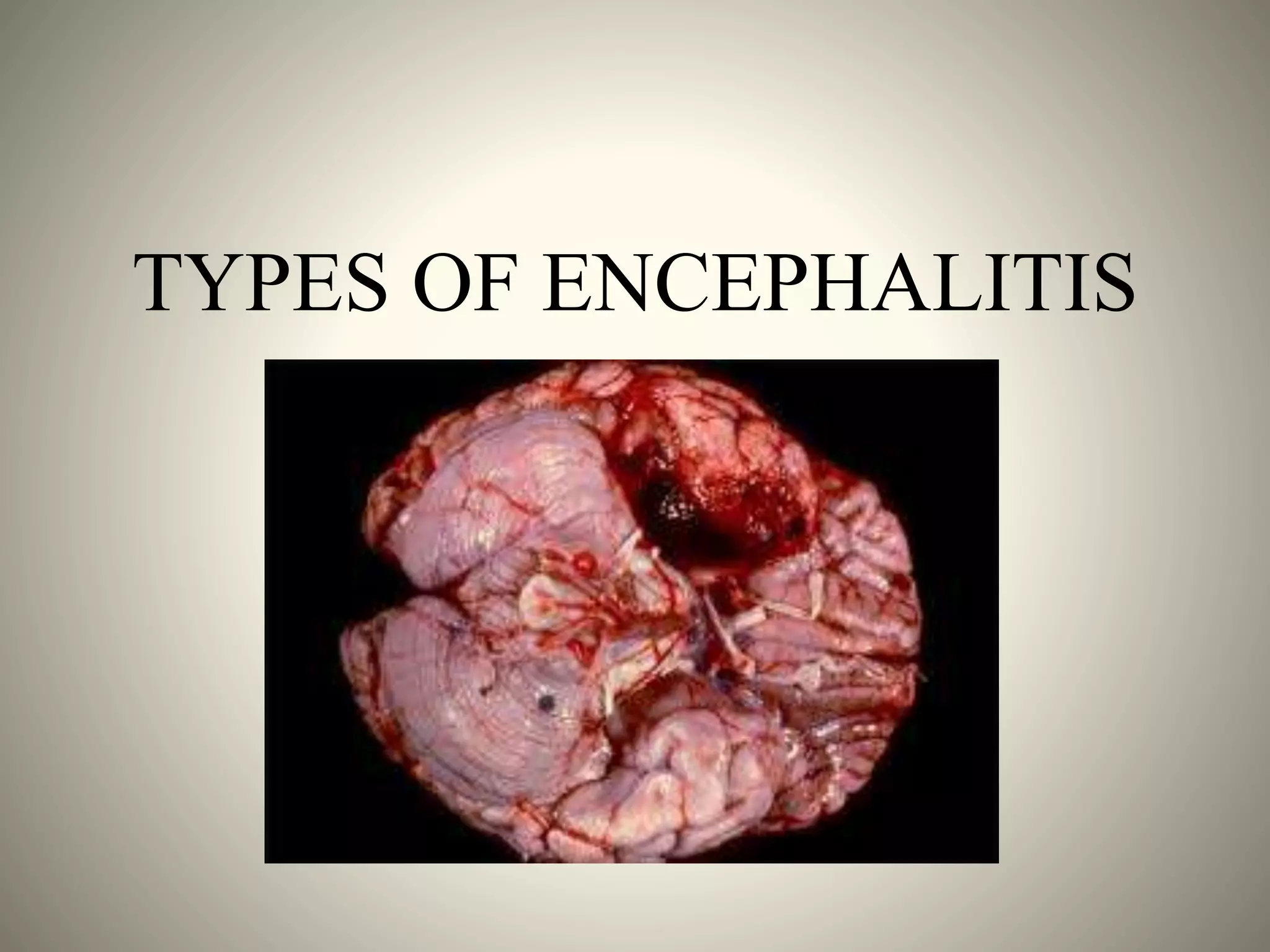 TYPES OF ENCEPHALITIS
 