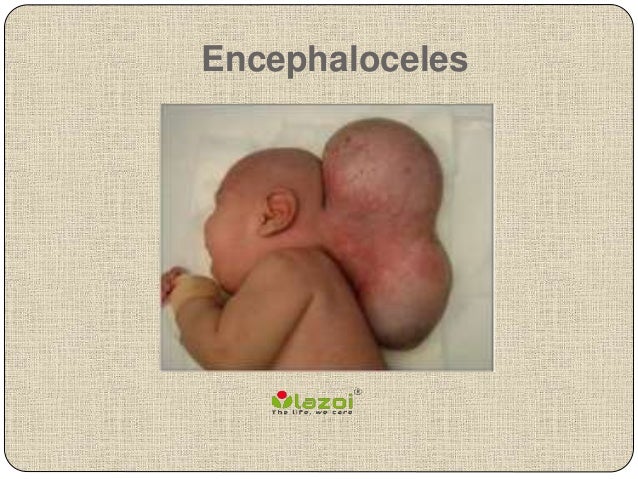encephaloceles-1-638.jpg