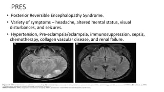 PRES
• Posterior Reversible Encephalopathy Syndrome.
• Variety of symptoms – headache, altered mental status, visual
disturbances, and seizures.
• Hypertension, Pre-eclampsia/eclampsia, immunosuppression, sepsis,
chemotherapy, collagen vascular disease, and renal failure.
 