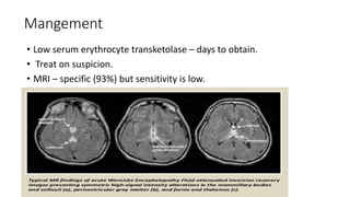 Mangement
• Low serum erythrocyte transketolase – days to obtain.
• Treat on suspicion.
• MRI – specific (93%) but sensitivity is low.
 