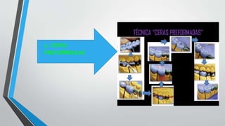 3 . CERAS
PREFORMADAS
 