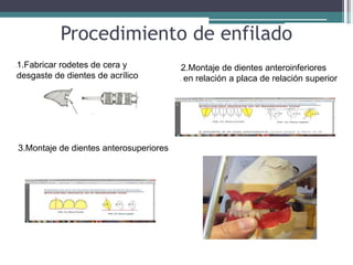 Procedimiento de enfilado
l1.Fabricar rodetes de cera y
ldesgaste de dientes de acrílico
l2.Montaje de dientes anteroinferiores
l en relación a placa de relación superior
l3.Montaje de dientes anterosuperiores
 