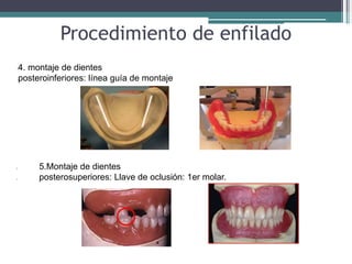 Procedimiento de enfilado
l4. montaje de dientes
lposteroinferiores: línea guía de montaje
l 5.Montaje de dientes
l posterosuperiores: Llave de oclusión: 1er molar.
 