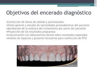 Objetivos del encerado diagnóstico
•Confección de llaves de tallado y provisionales
•Visión general y estudio de necesidades prostodónticas del paciente
•Aprobación de la estética del tratamiento por parte del paciente
•Proyección de los resultados propuestos
•Comunicación con laboratorista dental sobre resultados esperados
•Análisis de espacios y grosores necesarios para confección de PFU
 