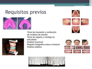 Requisitos previos
lToma de impresión y confección
lde modelos de estudio
lToma de registro y montaje en
larticulador
lAnálisis funcional
lRegistro fotográfico extra e intraoral
lAnálisis estético
 