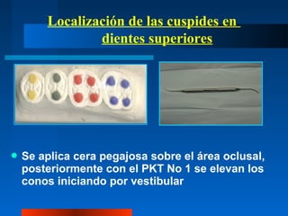 Localización de las cuspides en
dientes superiores
 Se aplica cera pegajosa sobre el área oclusal,
posteriormente con el PKT No 1 se elevan los
conos iniciando por vestibular
 