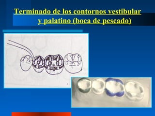 Terminado de los contornos vestibular
y palatino (boca de pescado)
 