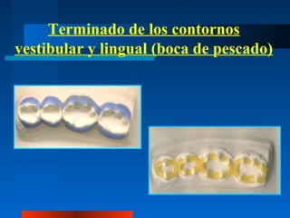 Terminado de los contornos
vestibular y lingual (boca de pescado)
 
