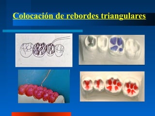 Colocación de rebordes triangulares
 