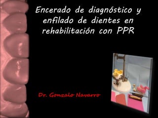 Encerado de diagnóstico y 
enfilado de dientes en 
rehabilitación con PPR 
Dr. Gonzalo Navarro 
 