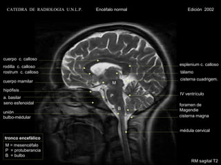 CATEDRA DE RADIOLOGIA U.N.L.P.   Encéfalo normal       Edición 2002




cuerpo c. calloso
rodilla c. calloso                                   esplenium c. calloso
rostrum c. calloso                                   tálamo

cuerpo mamilar                                       cisterna cuadrigem.
                                          M
hipófisis
                                         P           IV ventrículo
a. basilar
seno esfenoidal                                      foramen de
                                              B      Magendie
unión
bulbo-médular                                        cisterna magna


                                                     médula cervical
tronco encefálico
 M = mesencéfalo
 P = protuberancia
 B = bulbo
                                                           RM sagital T2
 