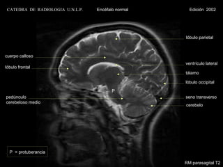 CATEDRA DE RADIOLOGIA U.N.L.P.   Encéfalo normal     Edición 2002




                                                    lóbulo parietal



cuerpo calloso
                                                    ventrículo lateral
lóbulo frontal
                                                    tálamo

                                                    lóbulo occipital

                                         P
pedúnculo                                           seno transverso
cerebeloso medio
                                                    cerebelo




  P = protuberancia

                                                    RM parasagital T2
 