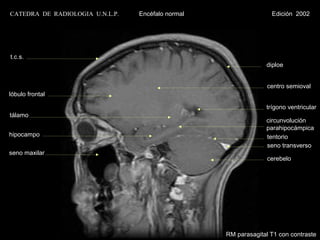 CATEDRA DE RADIOLOGIA U.N.L.P.   Encéfalo normal                  Edición 2002




t.c.s.
                                                                diploe


                                                                 centro semioval
lóbulo frontal

                                                                trígono ventricular
tálamo
                                                                circunvolución
                                                                parahipocámpica
hipocampo                                                       tentorio
                                                                seno transverso
seno maxilar
                                                                 cerebelo




                                                   RM parasagital T1 con contraste
 