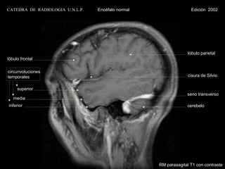 CATEDRA DE RADIOLOGIA U.N.L.P.   Encéfalo normal                  Edición 2002




                                                                 lóbulo parietal
lóbulo frontal

circunvoluciones
temporales                                                       cisura de Silvio


     superior
                                                                seno transverso
   media
inferior                                                        cerebelo




                                                   RM parasagital T1 con contraste
 