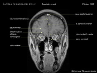 CATEDRA DE RADIOLOGIA U.N.L.P.   Encéfalo normal               Edición 2002




                                                       seno sagital superior

     cisura interhemisférica

                                                       a. cerebral anterior

      lóbulo frontal

      circunvolución
      orbitaria                                         circunvolución recta
      nervio óptico
                                                        seno etmoidal


      seno maxilar




                                                   RM coronal T1 con contraste
 