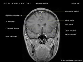 CATEDRA DE RADIOLOGIA U.N.L.P.   Encéfalo normal                Edición 2002



                                                       seno sagital superior

   cisura interhemisférica


                                                       lóbulo frontal
   a. pericallosa
                                                        asta frontal

   a. cerebral anterior
                                                       cisura de Silvio

                                                        lóbulo temporal
   seno esfenoidal




                                                   RM coronal T1 con contraste
 