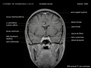 CATEDRA DE RADIOLOGIA U.N.L.P.   Encéfalo normal                Edición 2002



                                                       seno sagital superior

   cisura interhemisférica


   a. pericallosa                                      lóbulo frontal
   cuerpo calloso
                                                        asta frontal

   tercer ventrículo
                                                       cisura de Silvio
   tallo hipofisario                                   seno cavernoso
   hipófisis
                                                        lóbulo temporal
   seno esfenoidal




                                                   RM coronal T1 con contraste
 