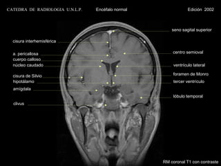 CATEDRA DE RADIOLOGIA U.N.L.P.   Encéfalo normal                Edición 2002



                                                       seno sagital superior

  cisura interhemisférica

  a. pericallosa                                       centro semioval
  cuerpo calloso
  núcleo caudado                                        ventrículo lateral

  cisura de Silvio                                     foramen de Monro
  hipotálamo                                            tercer ventrículo
  amígdala
                                                        lóbulo temporal
  clivus




                                                   RM coronal T1 con contraste
 