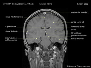 CATEDRA DE RADIOLOGIA U.N.L.P.   Encéfalo normal                Edición 2002



                                                       seno sagital superior

  cisura interhemisférica

                                                       centro semioval

  a. pericallosa                                        ventrículo lateral
                                                       ínsula
  cisura de Silvio
                                                        III ventrículo
                                                        pedúnculo cerebral
  circunvolución                                        lóbulo temporal
  del hipocampo




                                                   RM coronal T1 con contraste
 