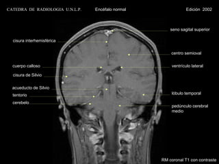 CATEDRA DE RADIOLOGIA U.N.L.P.   Encéfalo normal                Edición 2002



                                                       seno sagital superior

  cisura interhemisférica

                                                       centro semioval


  cuerpo calloso                                        ventrículo lateral

  cisura de Silvio


  acueducto de Silvio
  tentorio                                              lóbulo temporal

  cerebelo
                                                        pedúnculo cerebral
                                                        medio




                                                   RM coronal T1 con contraste
 