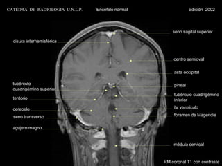 CATEDRA DE RADIOLOGIA U.N.L.P.   Encéfalo normal                 Edición 2002




                                                       seno sagital superior

  cisura interhemisférica



                                                       centro semioval


                                                        asta occipital

  tubérculo                                             pineal
  cuadrigémino superior
                                                        tubérculo cuadrigémino
  tentorio                                              inferior

  cerebelo                                              IV ventrículo

  seno transverso                                       foramen de Magendie


  agujero magno


                                                       médula cervical



                                                   RM coronal T1 con contraste
 